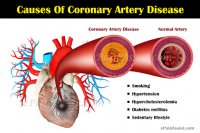 causes-of-coronary-artery-disease.jpg