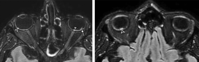 3D FLAIR-weighted MRI reformatted in the axial plane showing several hyperintense nodules of the posterior pole of the globe located in the macular region (white arrowhead) and the extramacular region (black arrowheads) in a 56-year-old man presenting with severe COVID-19. Note the presence of a focal temporal retinal detachment of the left eye (arrow).