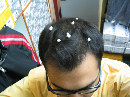 dandruff.jpg