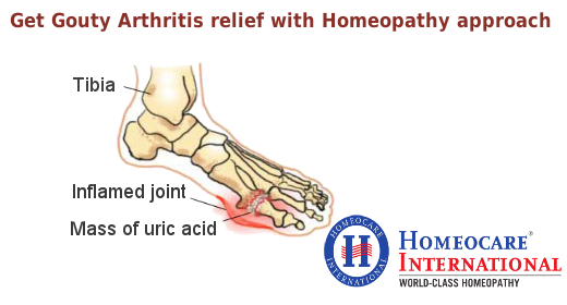 Gouty-Arthritis-Treatment.jpg